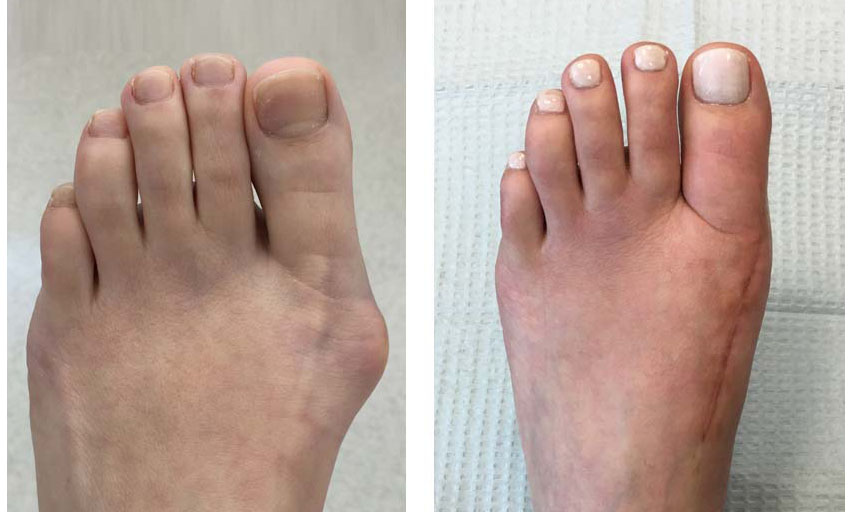 bunions-before-after-surgery