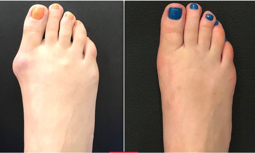 bunions-before-after-surgery2