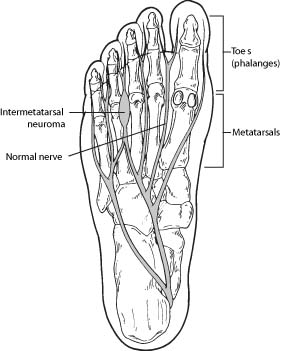 F-66-and-F-135-Neuroma-2009
