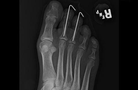 ResizedImage458300-Hammertoes