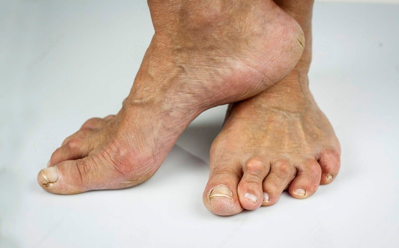 aaaaaaaarheumatoid-arthritis-ffeet-cracked-skin-toe-45331409-transformed