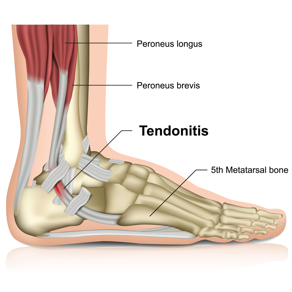 peroneal tendonitis ,ankle joint 3d medical vector illustration eps 10