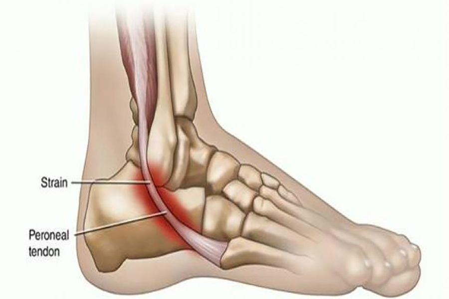 Peroneal-Tendonitis