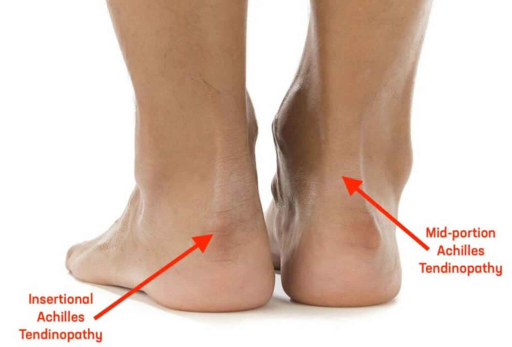 podiatrists-for-achilles-tendonitis-in-mckenzie-towne