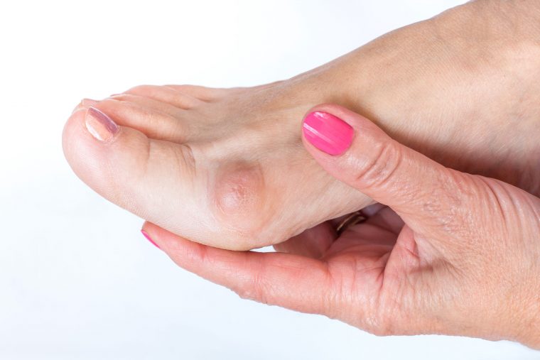 Treatment for Bunion