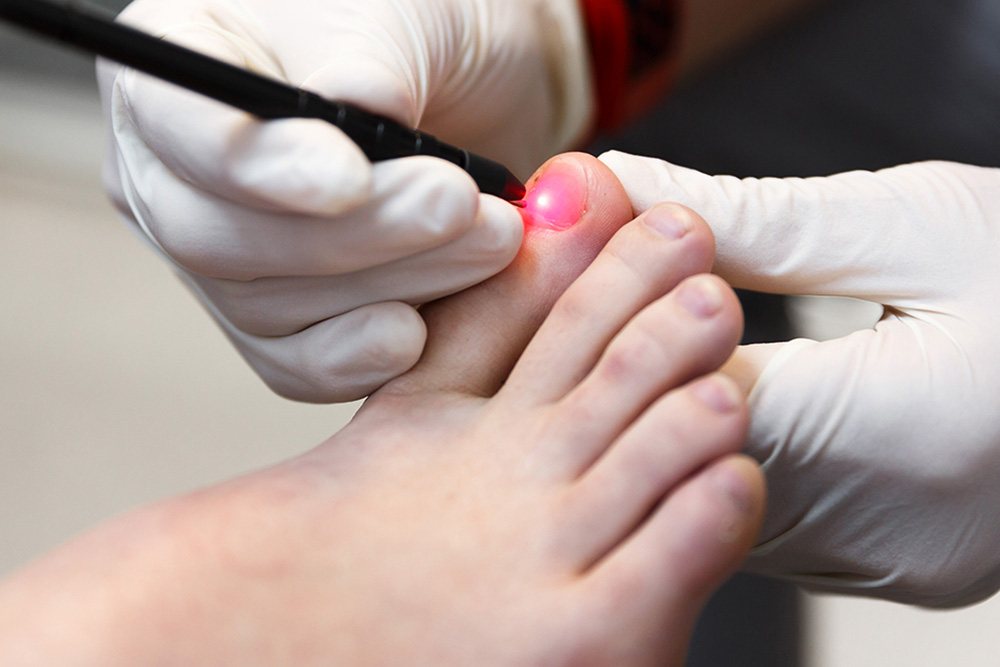 Fungal-Nail-Laser-Therapy-My-FootDr