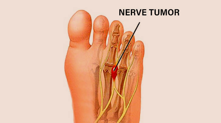 Podiatrists For Mortons Neuroma In Edgemont Calgary 8235