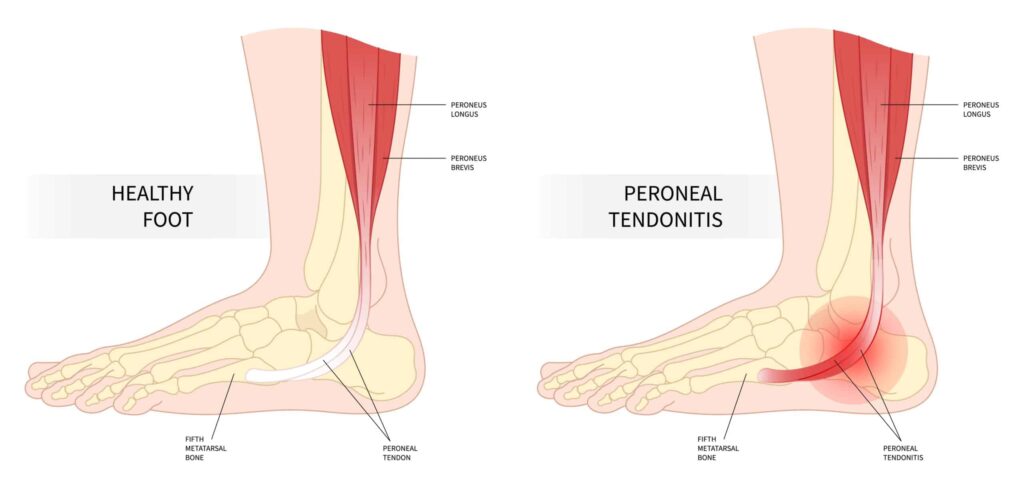 Podiatrists for Peroneal Tendon Surgery in Bridlewood