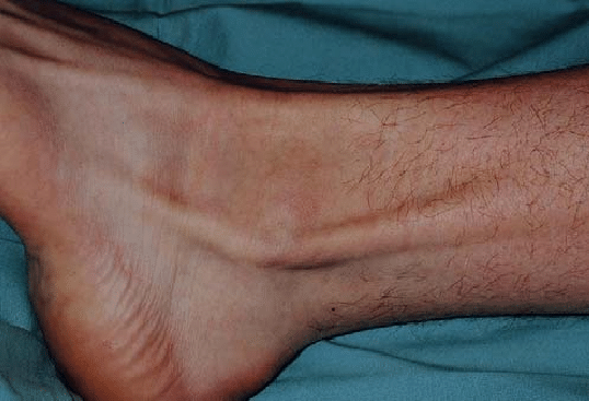 Subluxation-of-peroneal-tendons