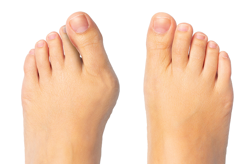 bunion-surgery-recovery-tips