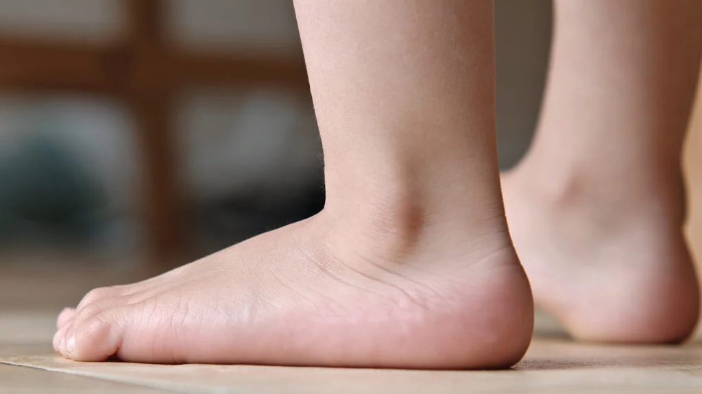 Facts about Flat Feet
