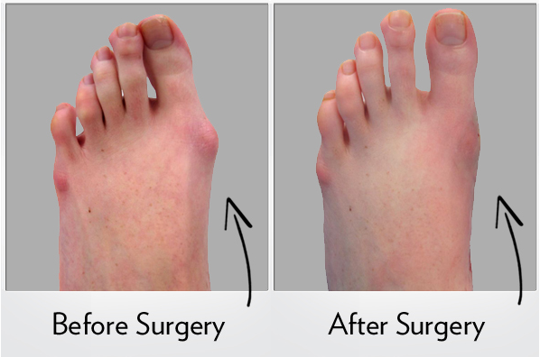 Hammertoe, Valley Foot Ankle Center