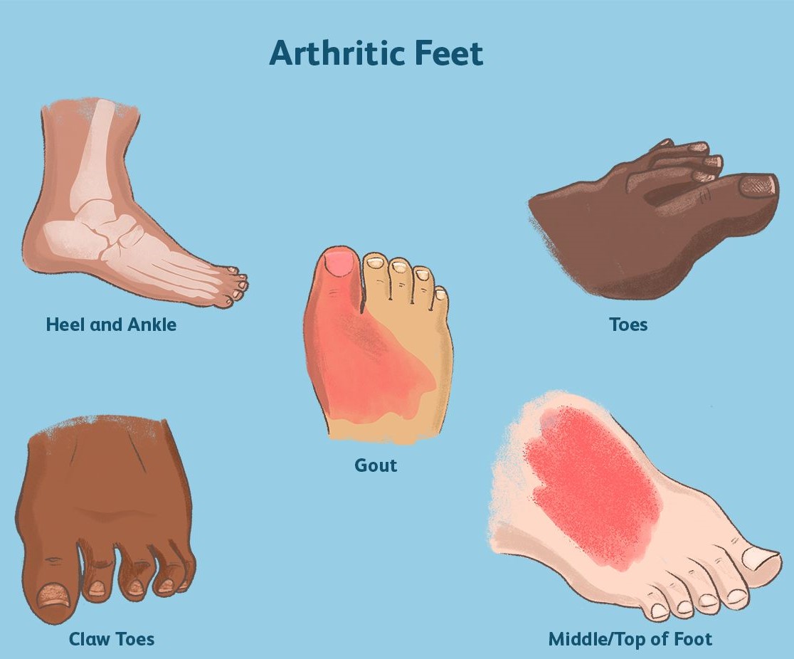 pictures-of-arthritis-in-feet-