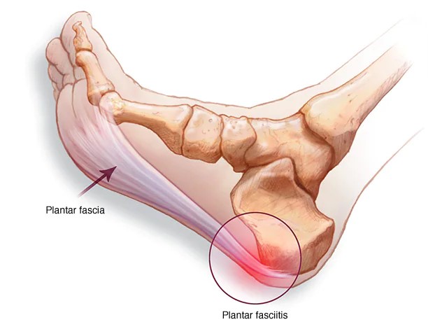 All about Plantar Fasciitis