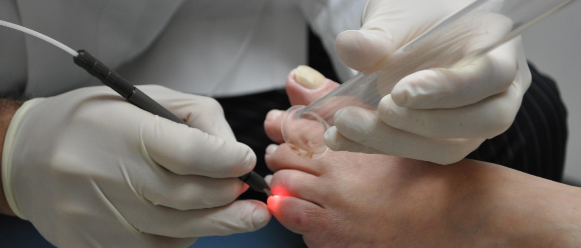 toenail-fungus-laser-removal-1170x500