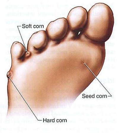 Foot Corns