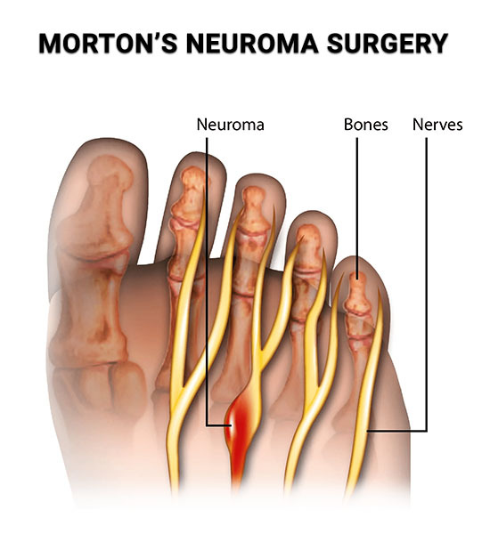 Morton's Neuroma