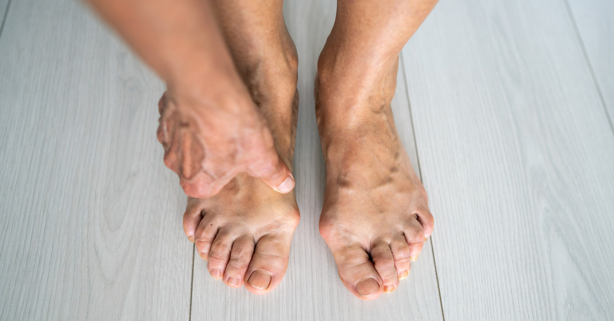 Bunion Self Assessment Featured Image