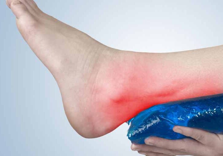 10-Effective-Home-Remedies-To-Treat-Achilles-Tendon-Pain1