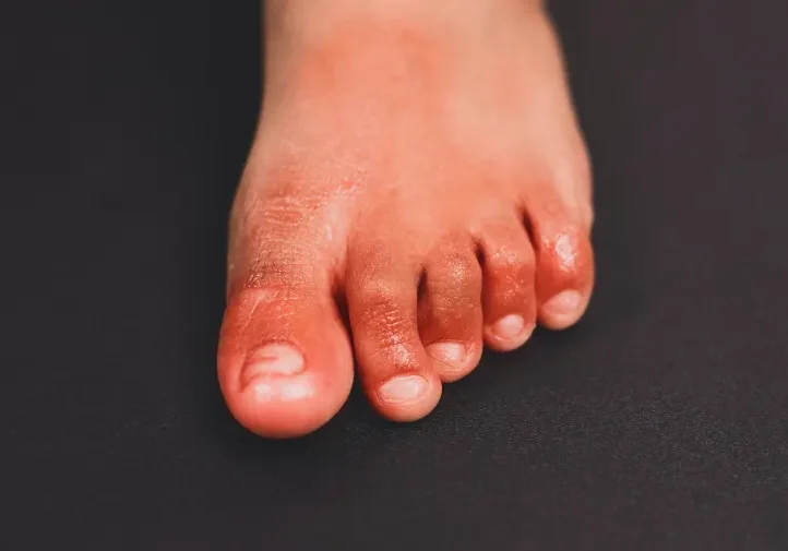 1arthritis-in-feet-