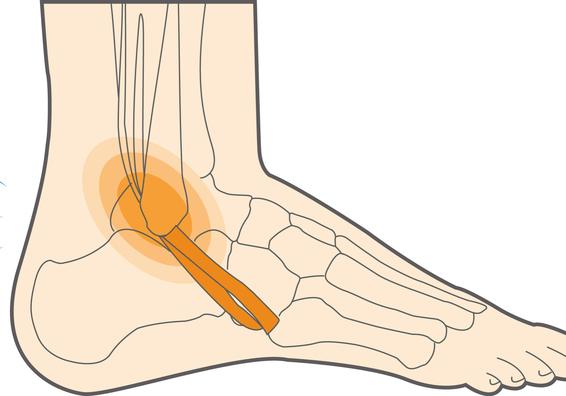 5.peroneal-tendoinis