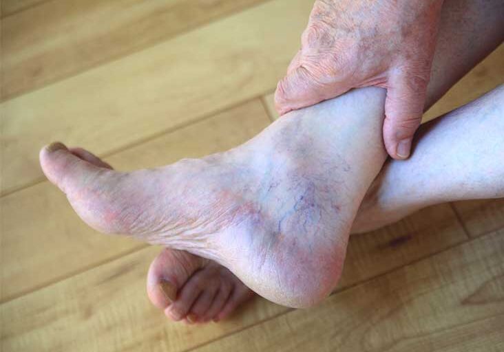 732x549_Psoriatic_Arthritis-Hands_Feetarthritis-in-feet-