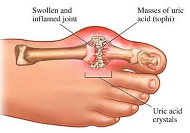 Big Toe Arthritis - The Frankel Foot & Ankle Center