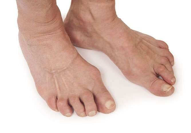 Arthritisarthritis-in-feet2-