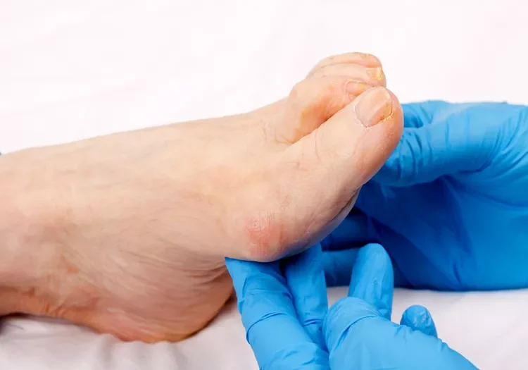 Arthritisintoesarthritis-in-feet-