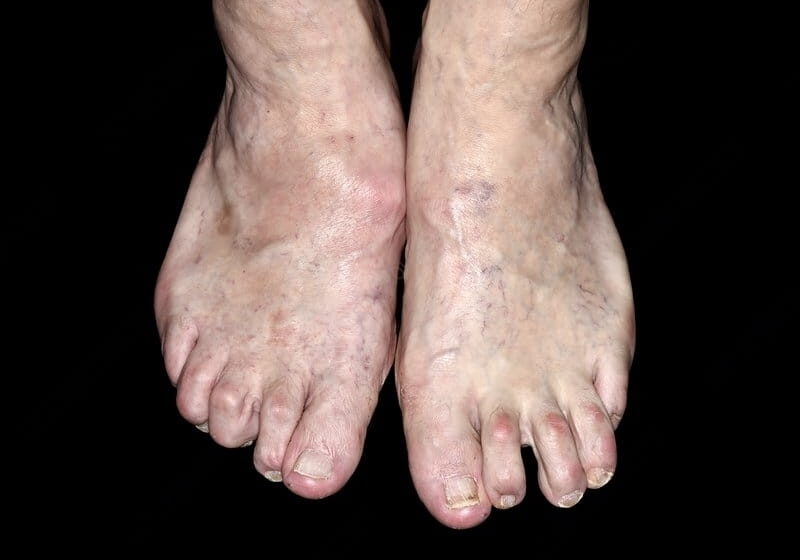 C0478459-Feet_in_severe_osteoarthritis-transformed