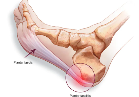 All about Plantar Fasciitis