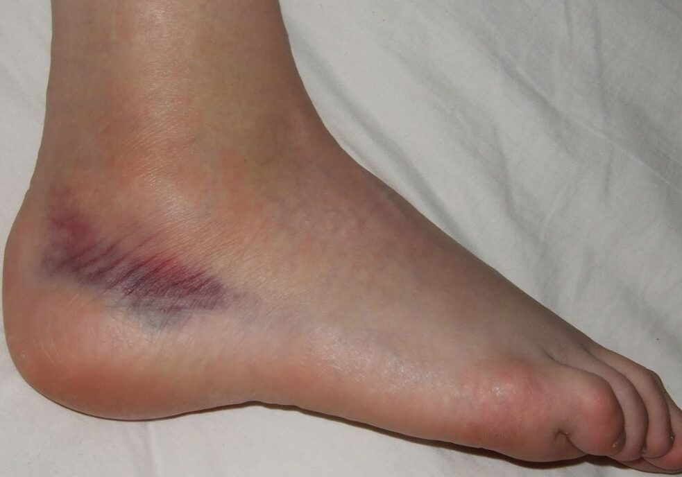 ankle injury