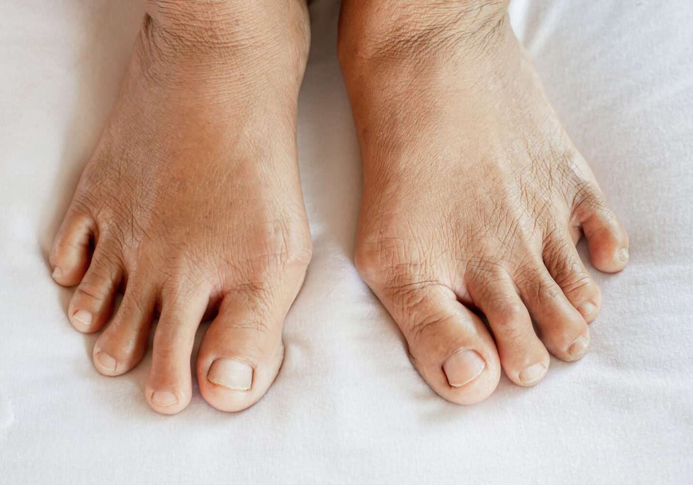 arthritis-in-feet-
