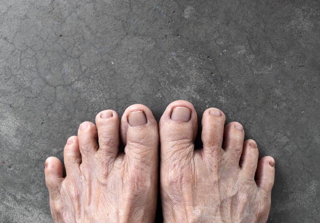 arthritis-in-feet1-