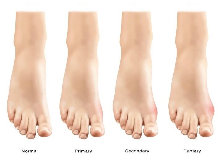 arthritis-in-feet2-