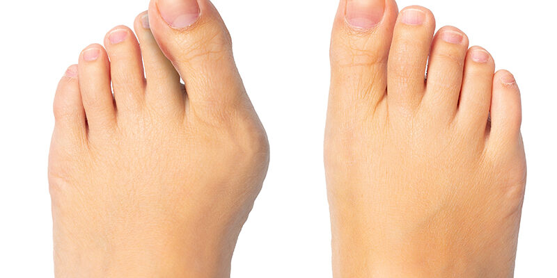 bunion-surgery-recovery-tips