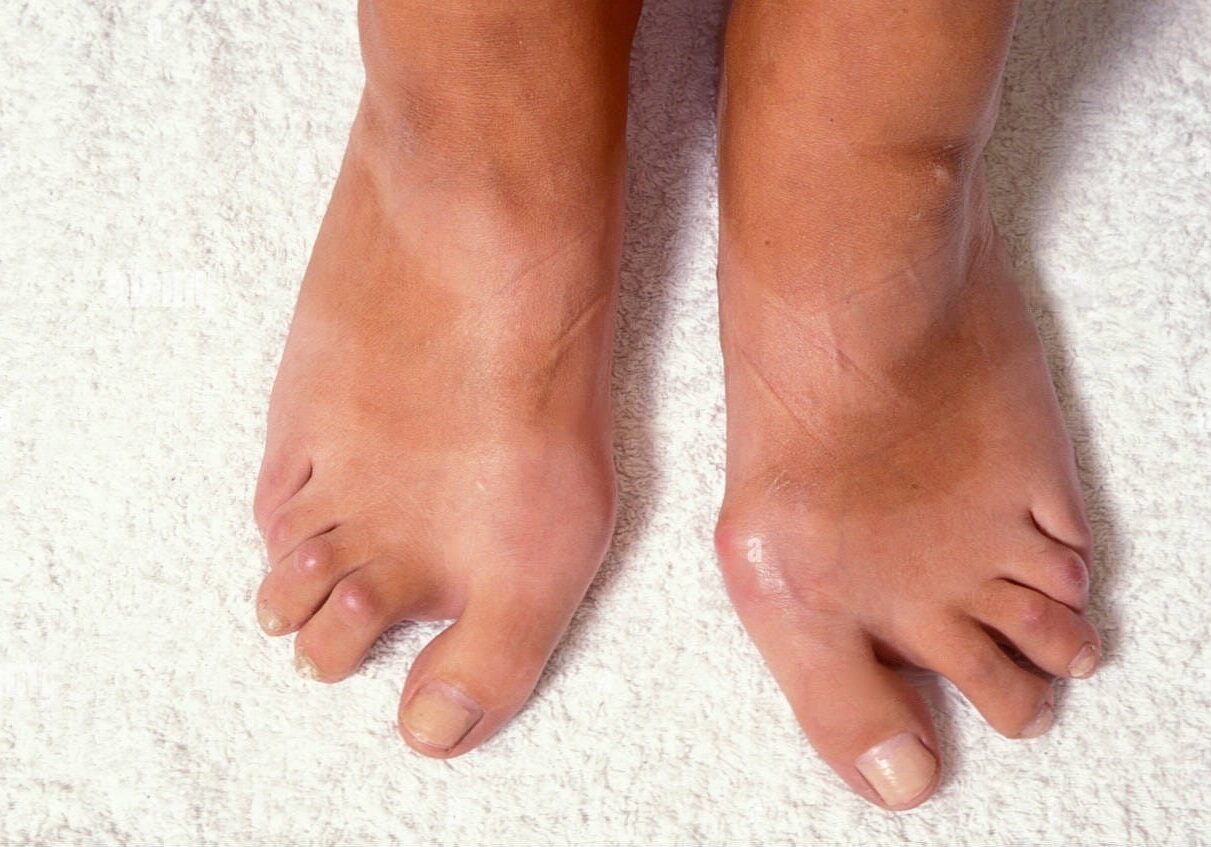feet-of-adult-woman-deformed-by-osteo-arthritis-arthritis-in-feet-