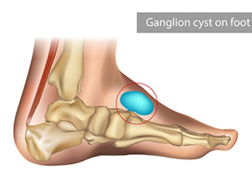 ganglion-cyst-1