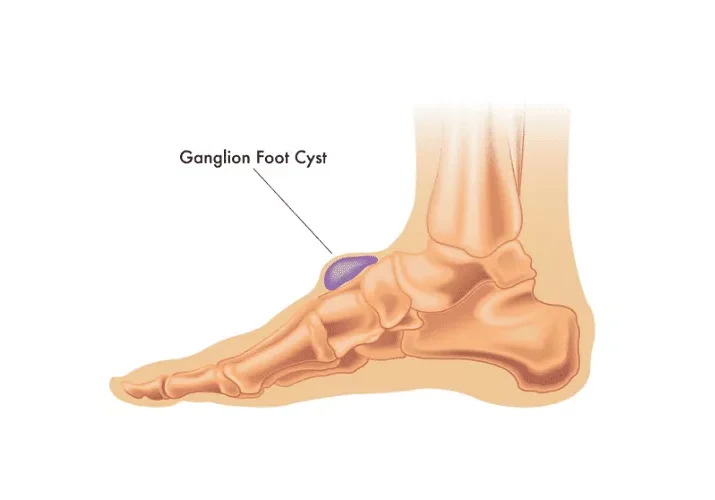 Podiatrists For Ganglion Cyst Surgery In Panorama Hills