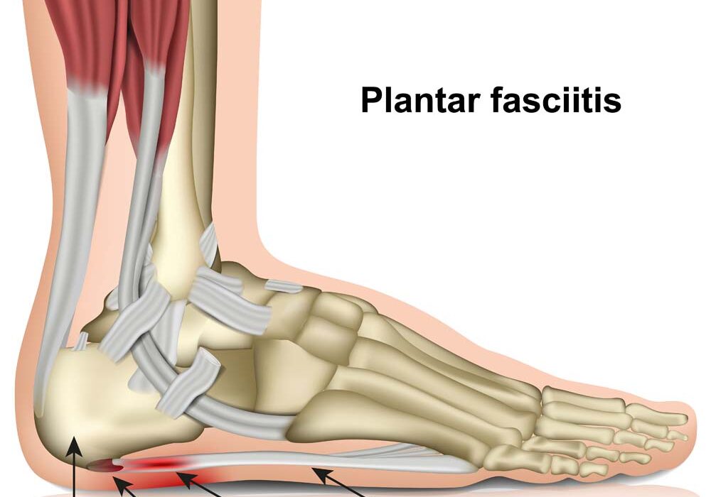 plantar fasciitis 3d medical vector illustration on white background eps 10